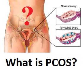 What is PCOS or Polycystic Ovarian Syndrome?